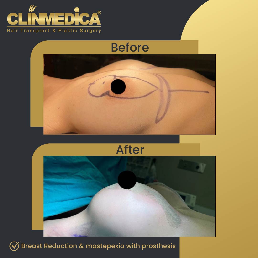 Mastepexia and breast reduction before and after in Turkey