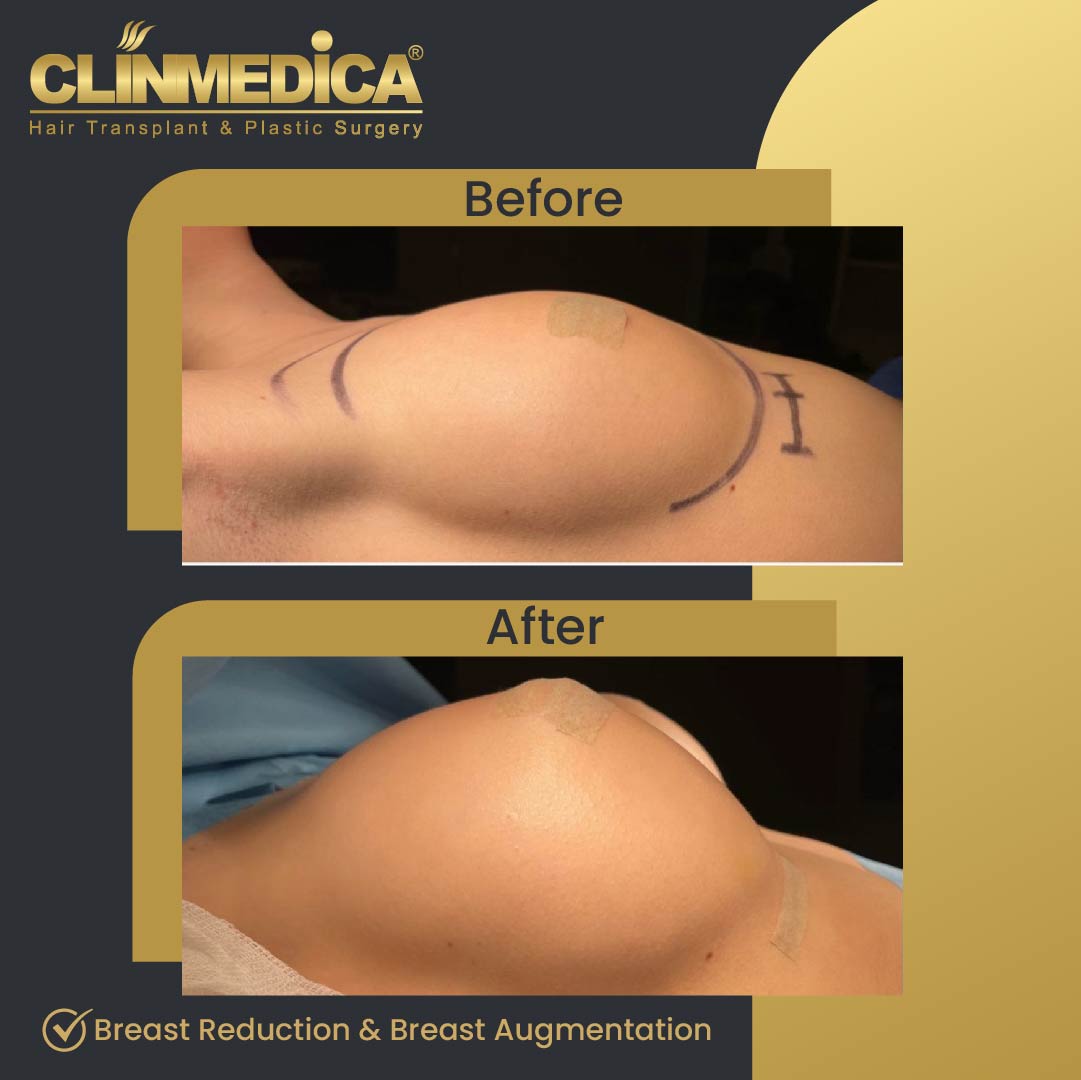 Mastepexia and breast reduction before and after in Turkey