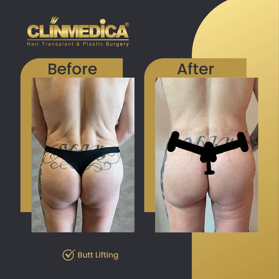 Butt Lifting before and after in Turkey