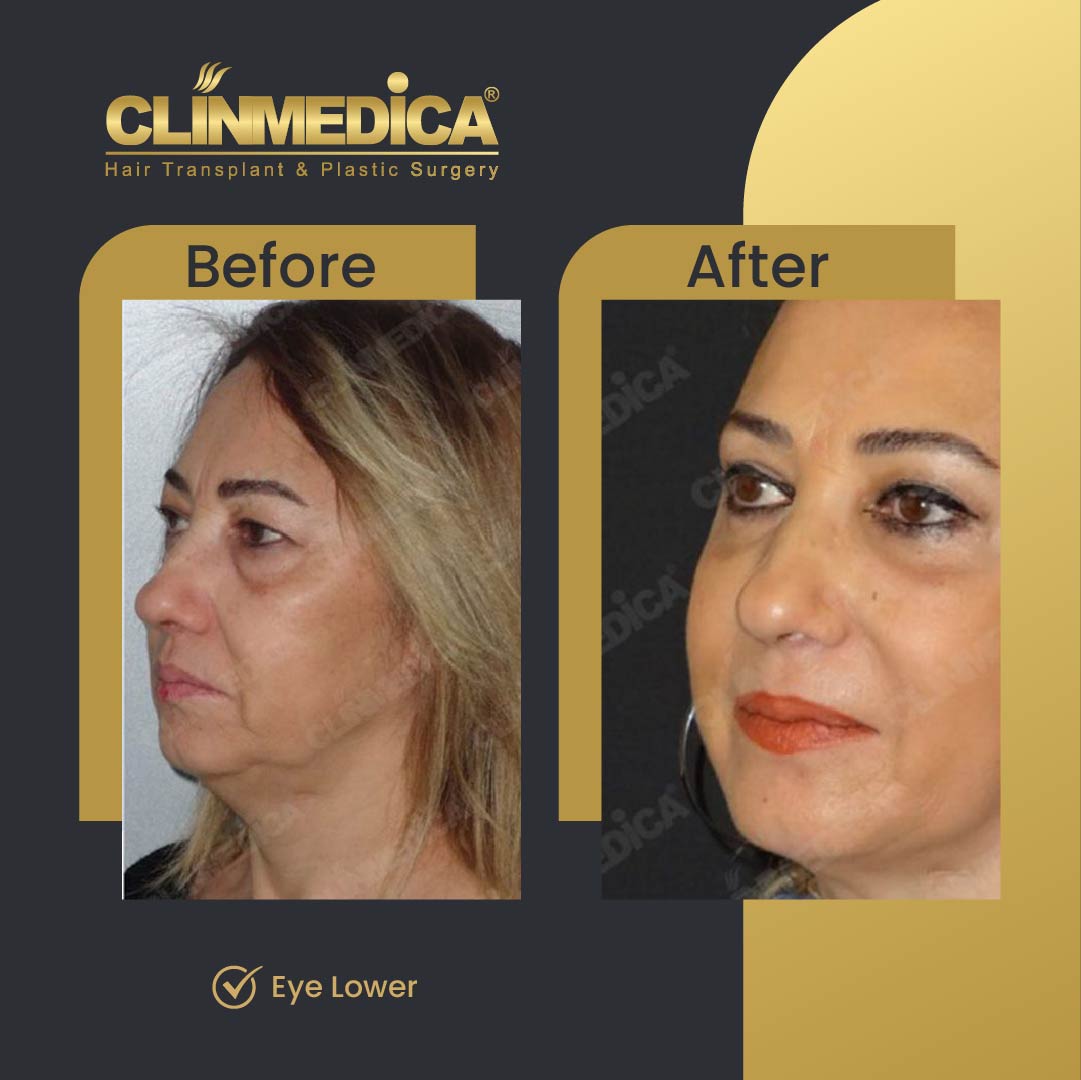 Eye Lower Surgery before and after in Turkey