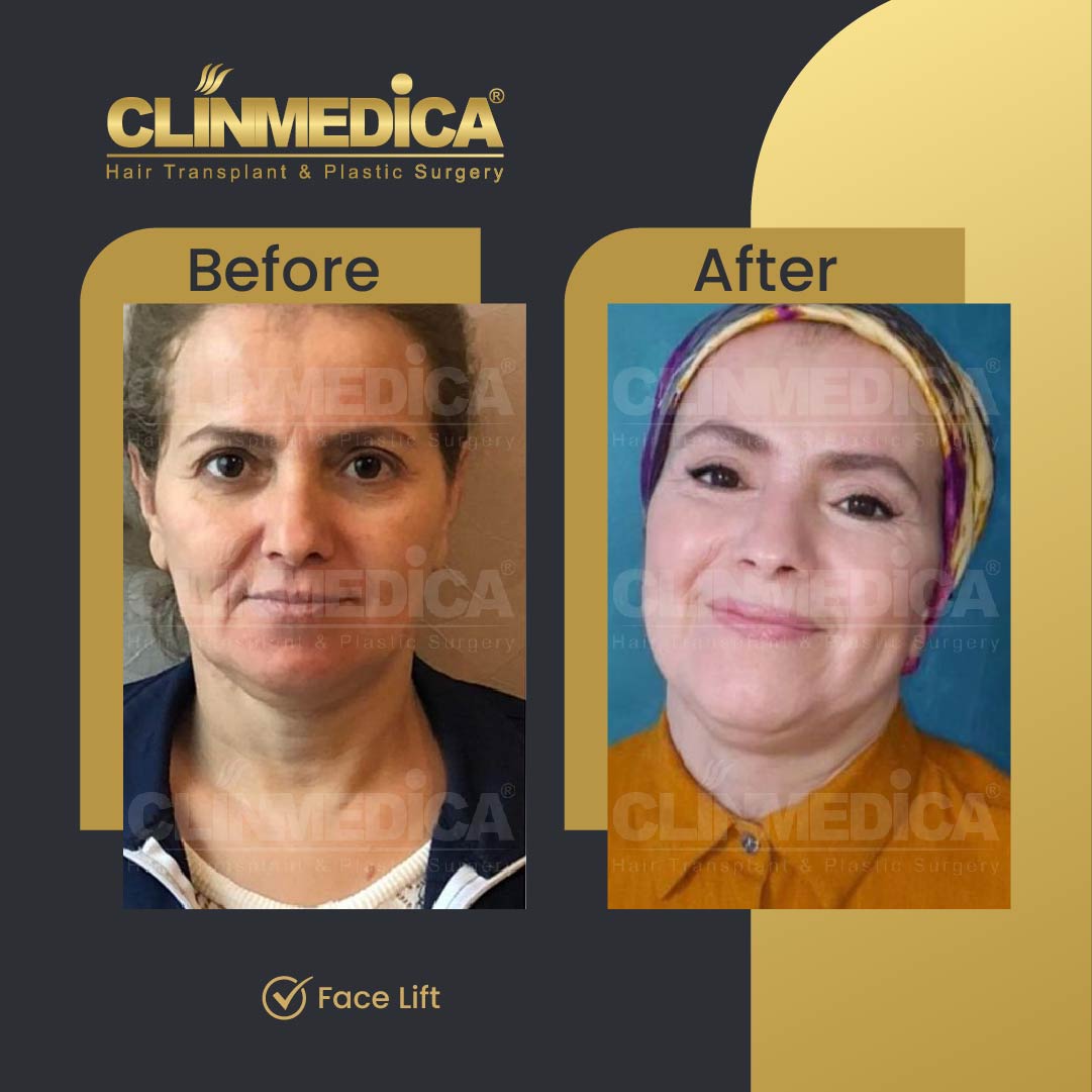 Face Lift oteoplasty before and aftr in Turkey
