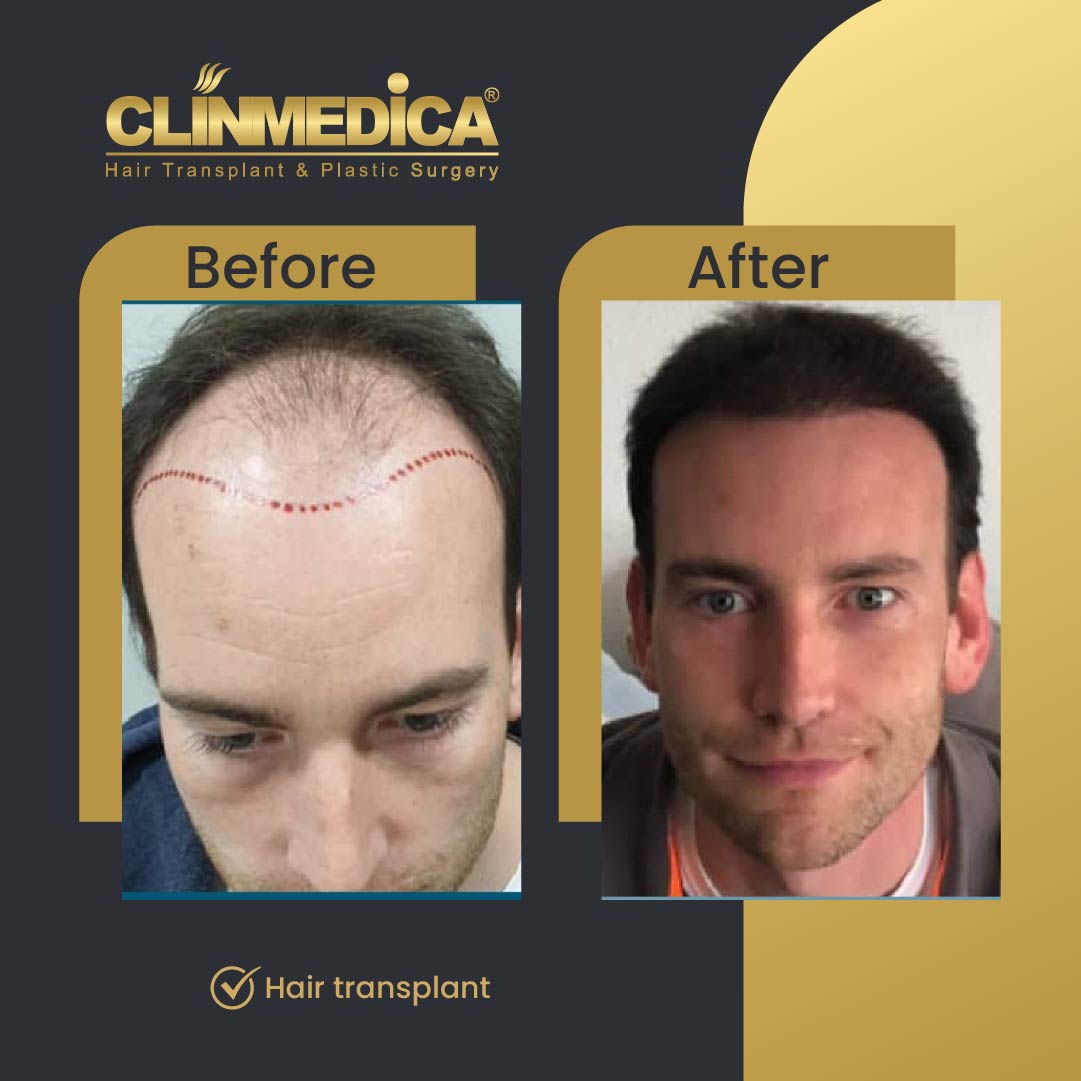 FUE Sapphire  hair transplant results before after in turkey