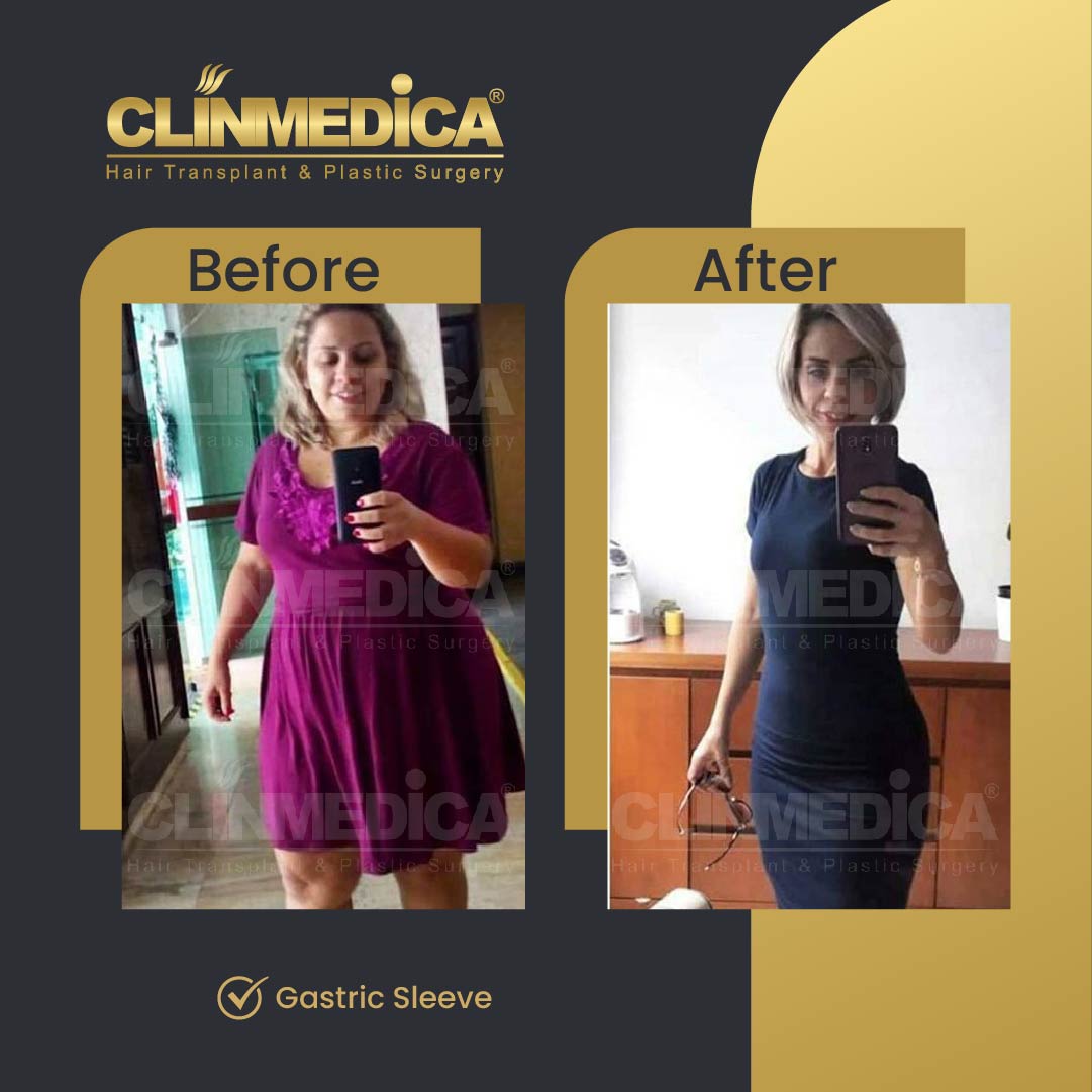 Gastric Sleeve before and after in Turkey