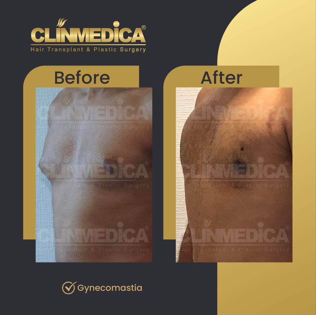 Gynecomastia surgery before and after in Turkey