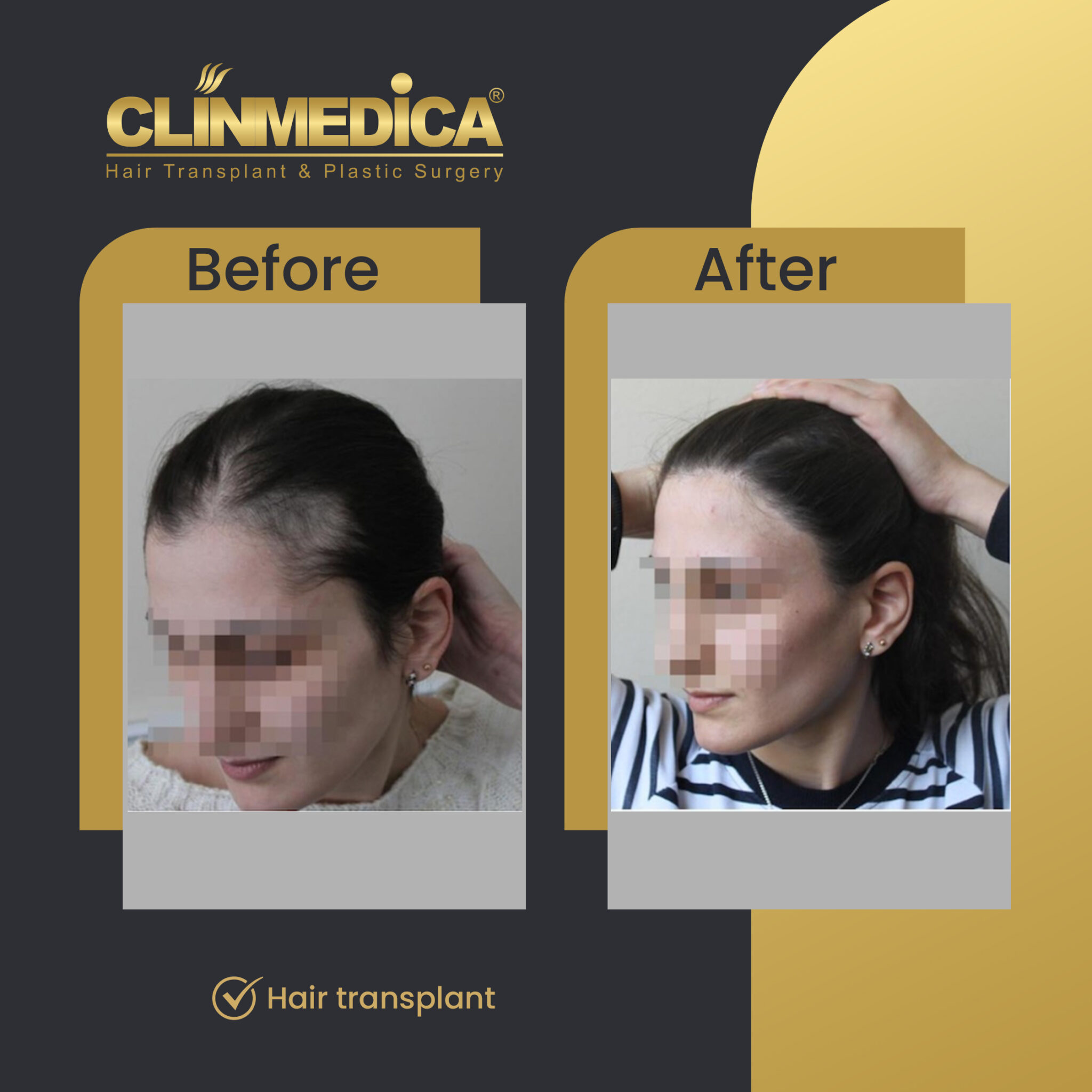 Hair-Transplant-for-women-Before-&-After-clinmedica-01