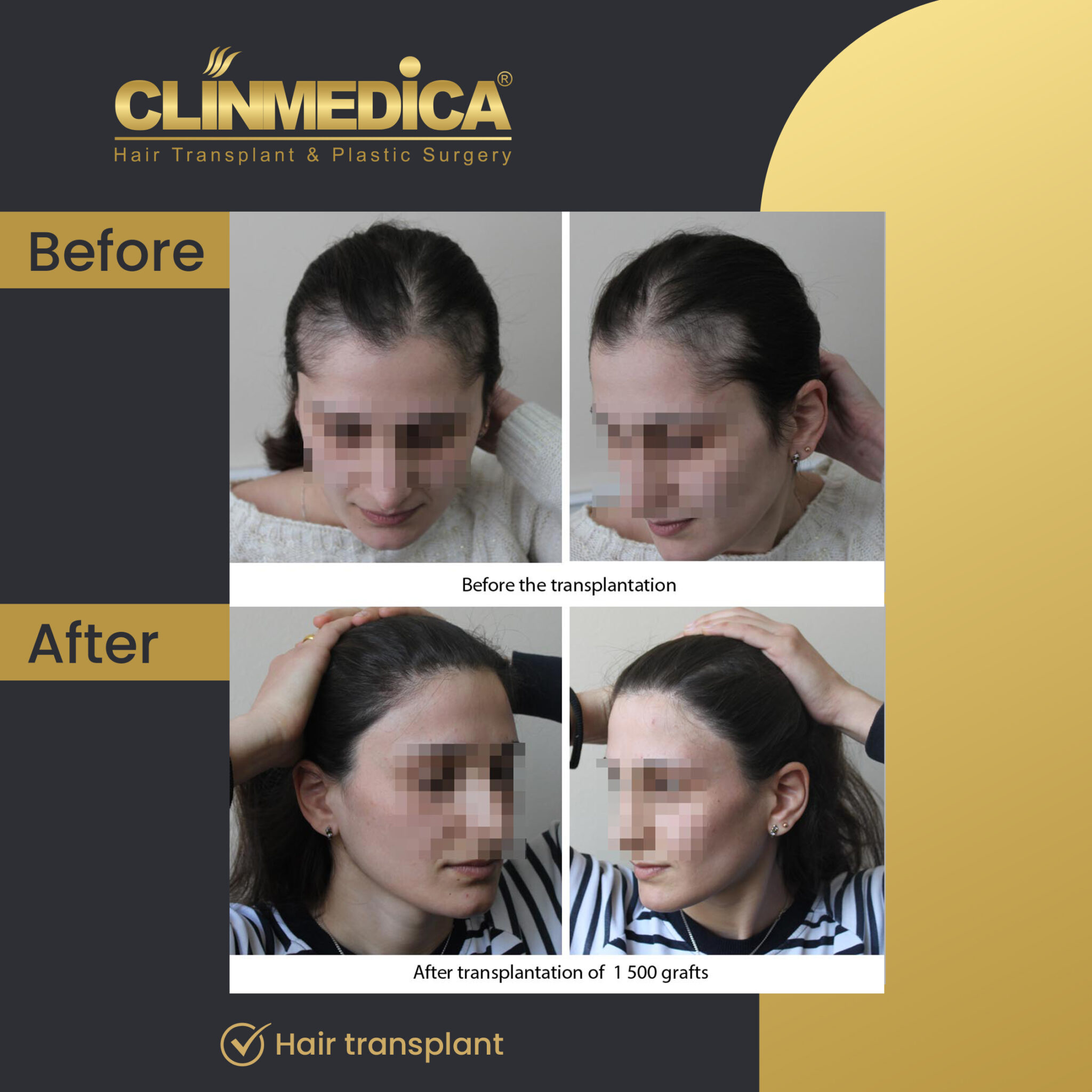Hair-Transplant-for-women-Before-&-After-clinmedica-03