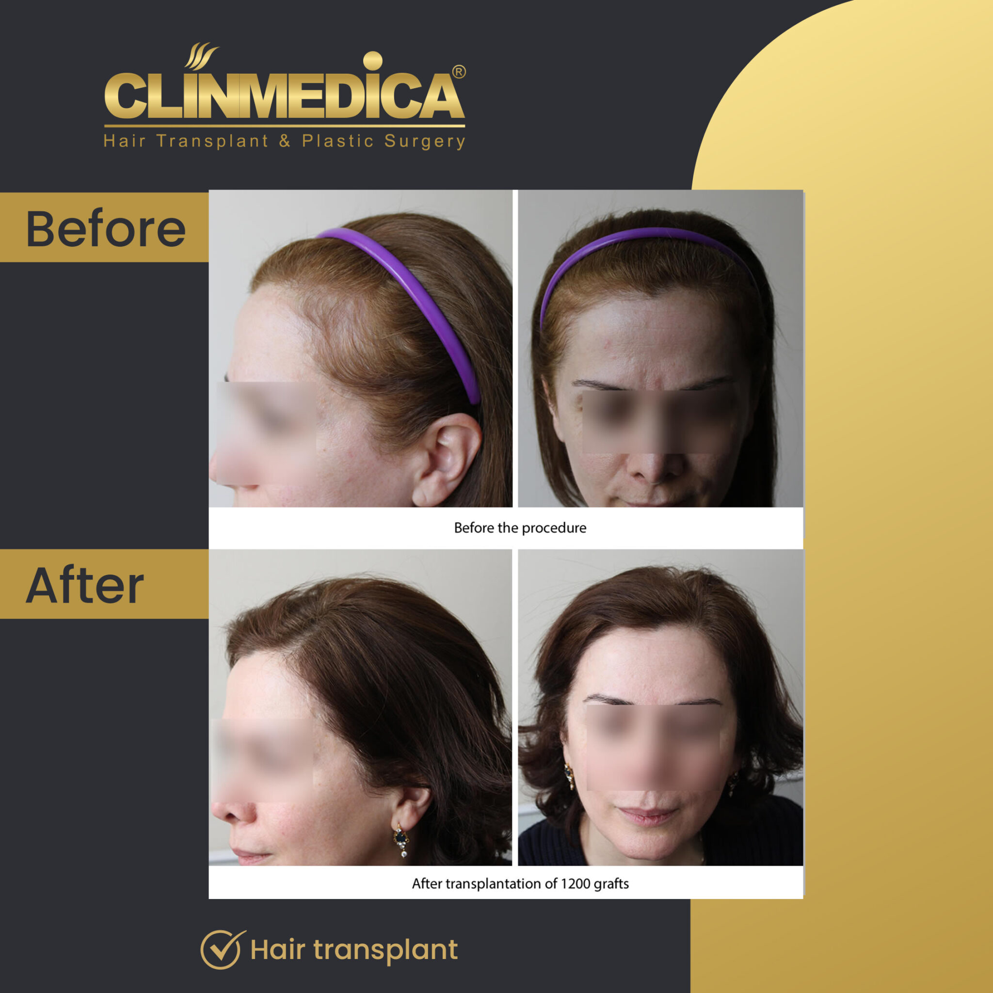 Hair-Transplant-for-women-Before-&-After-clinmedica-06