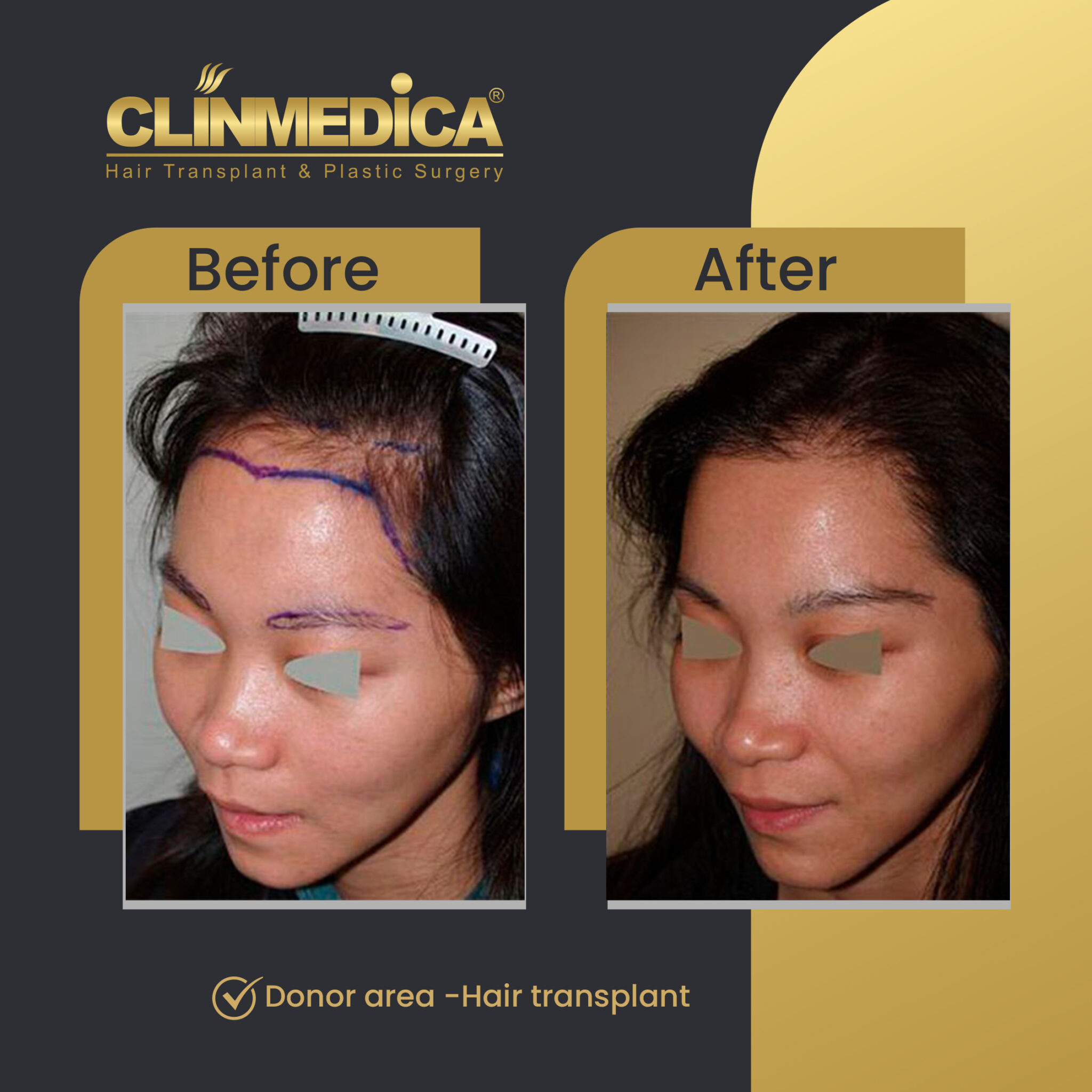 Hair-Transplant-for-women-Before-&-After-clinmedica-22.jpg-