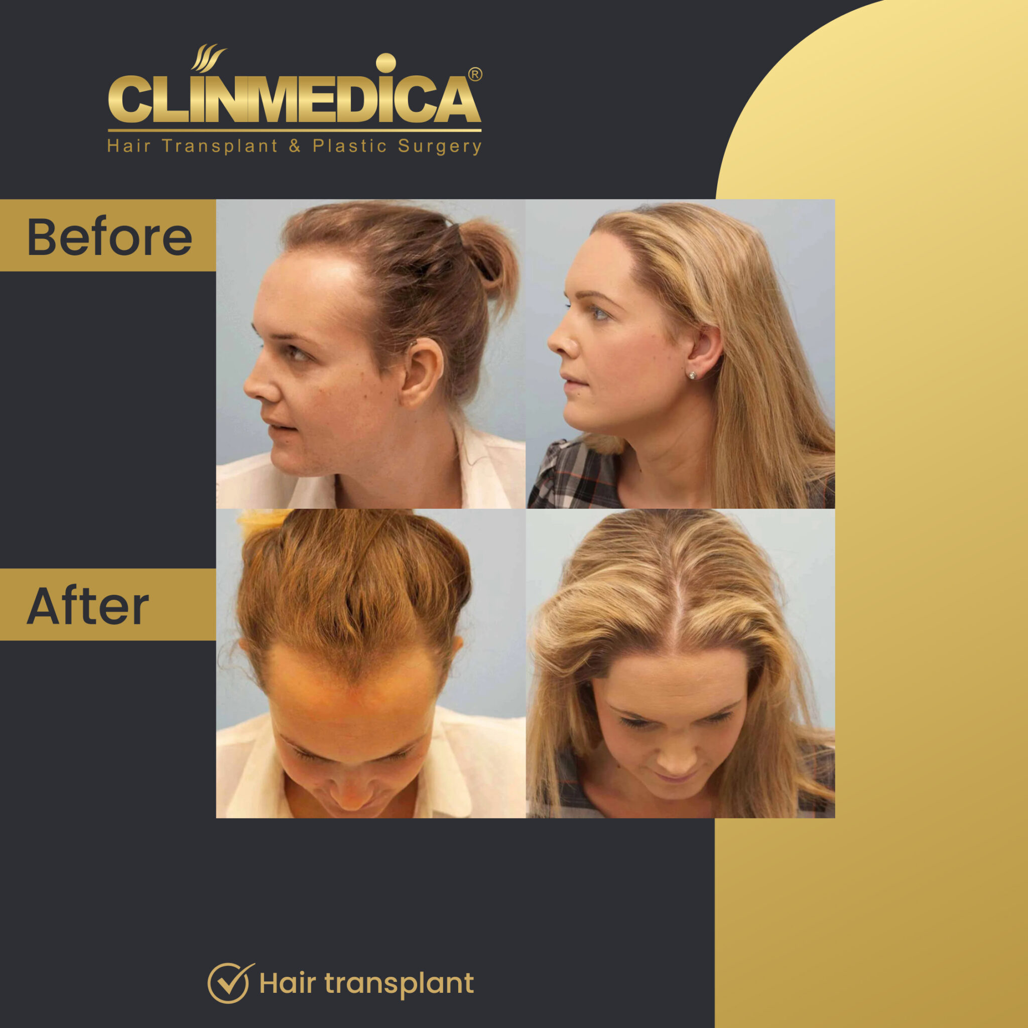 Hair-Transplant-for-women-Before-&-After-clinmedica-23.jpg-