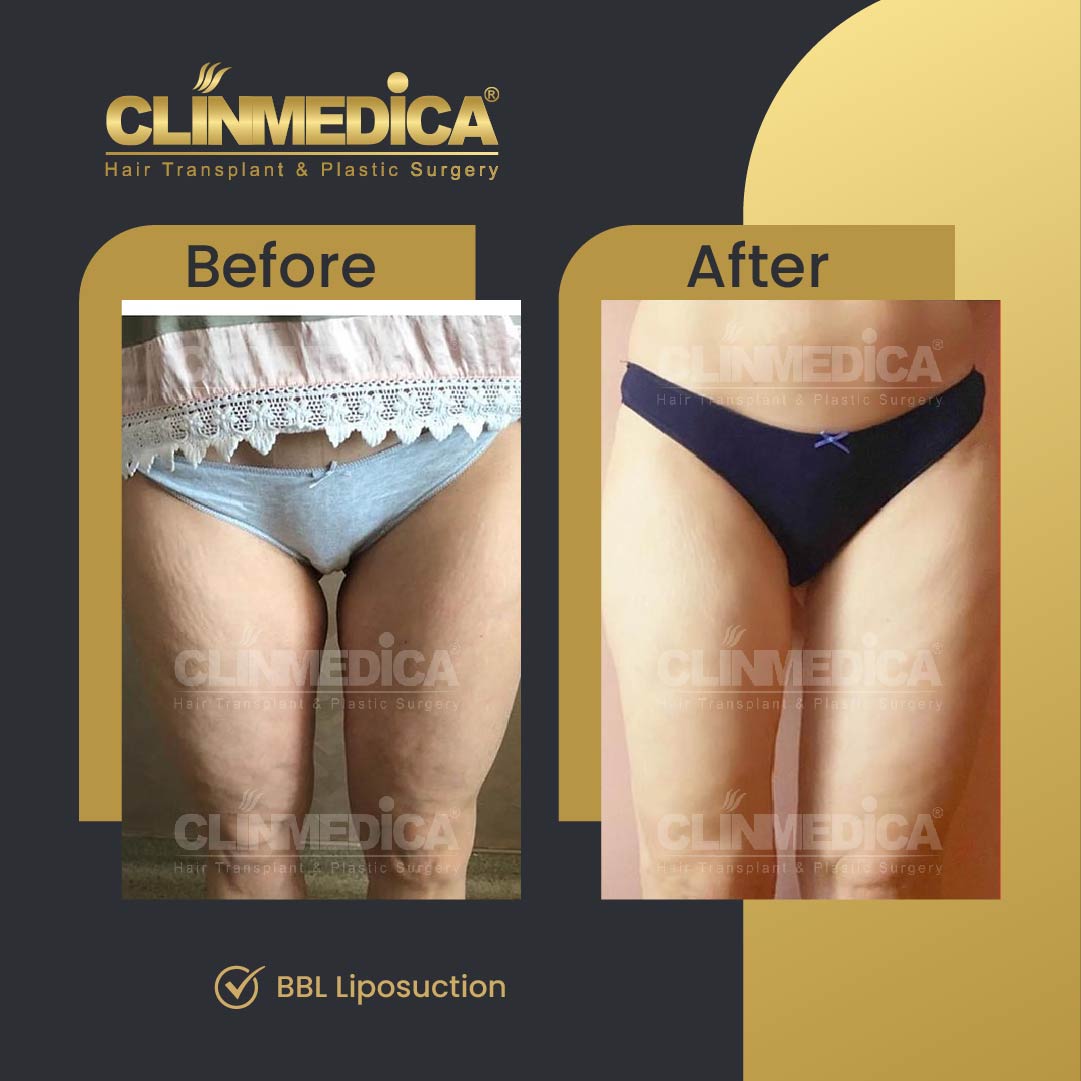 Liposuction surgery before and after in Turkey