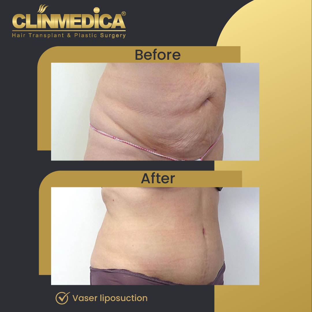 Liposuction surgery before and after in Turkey
