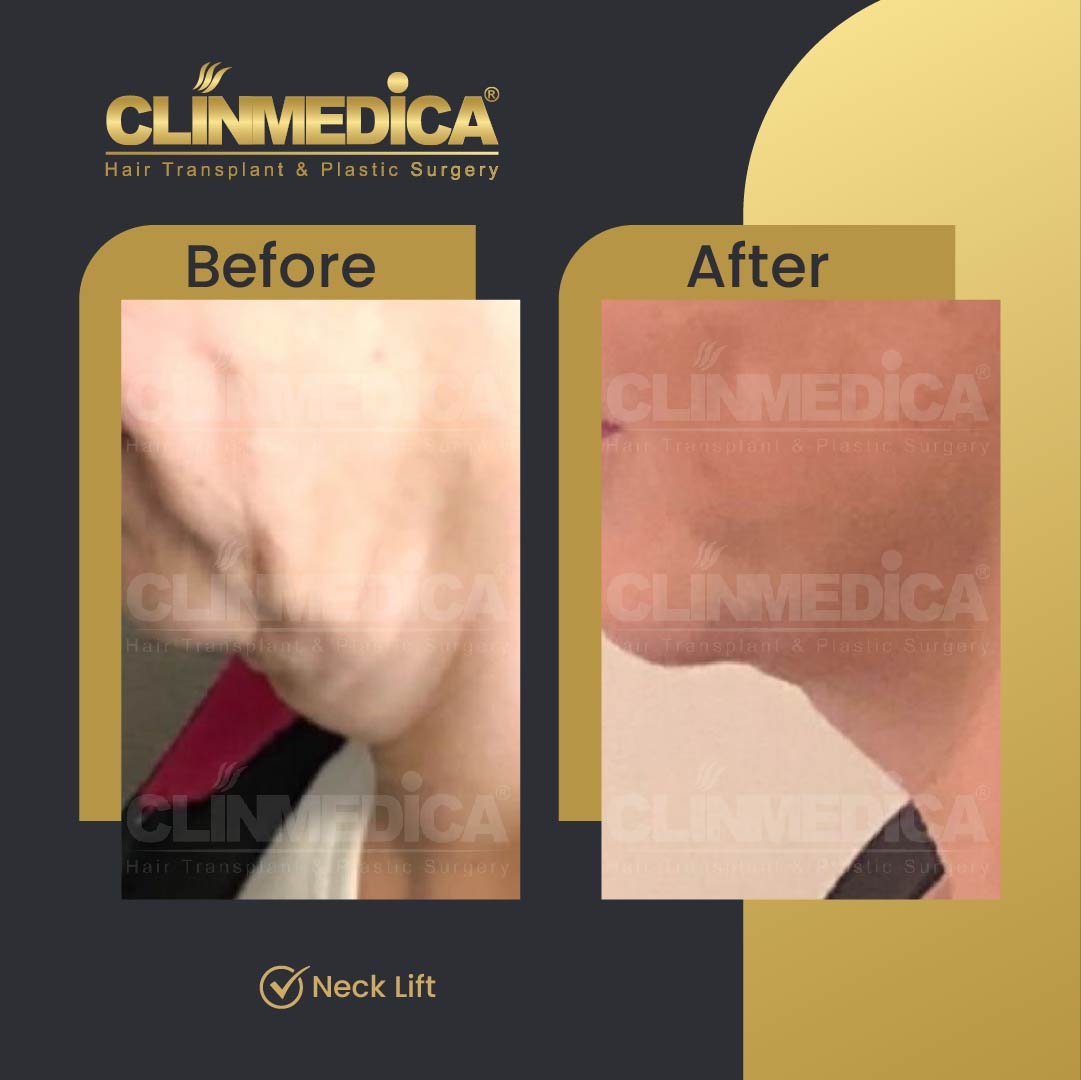 Neck Lift surgery before and after in Turkey