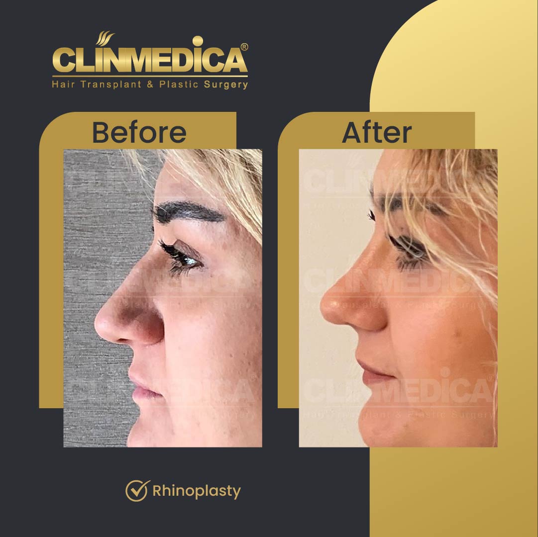 Rhinoplasty surgery before and after in Turkey