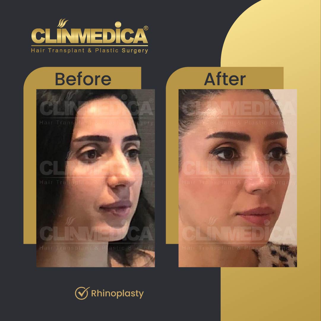 Rhinoplasty surgery before and after in Turkey