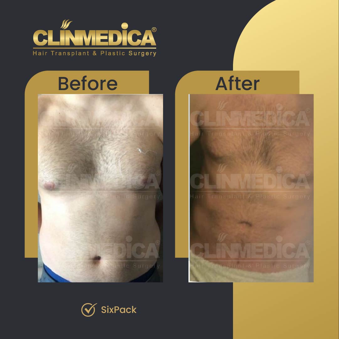 SixPacks surgery before and after in Turkey