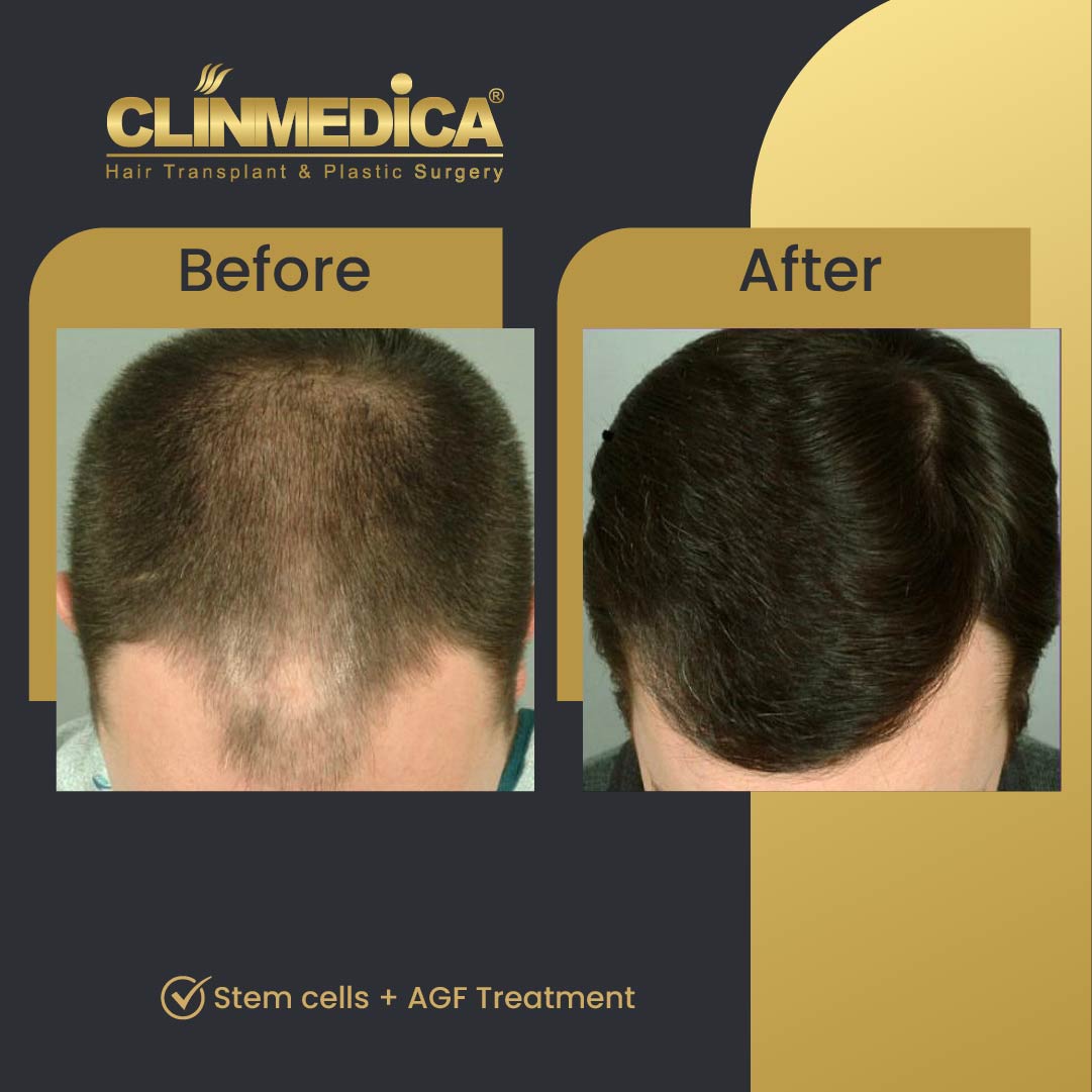 stem cells hair transplant before and after results in turkey