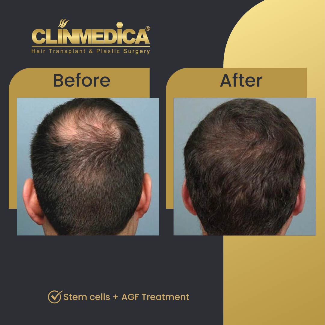 stem cells hair transplant before and after results in turkey