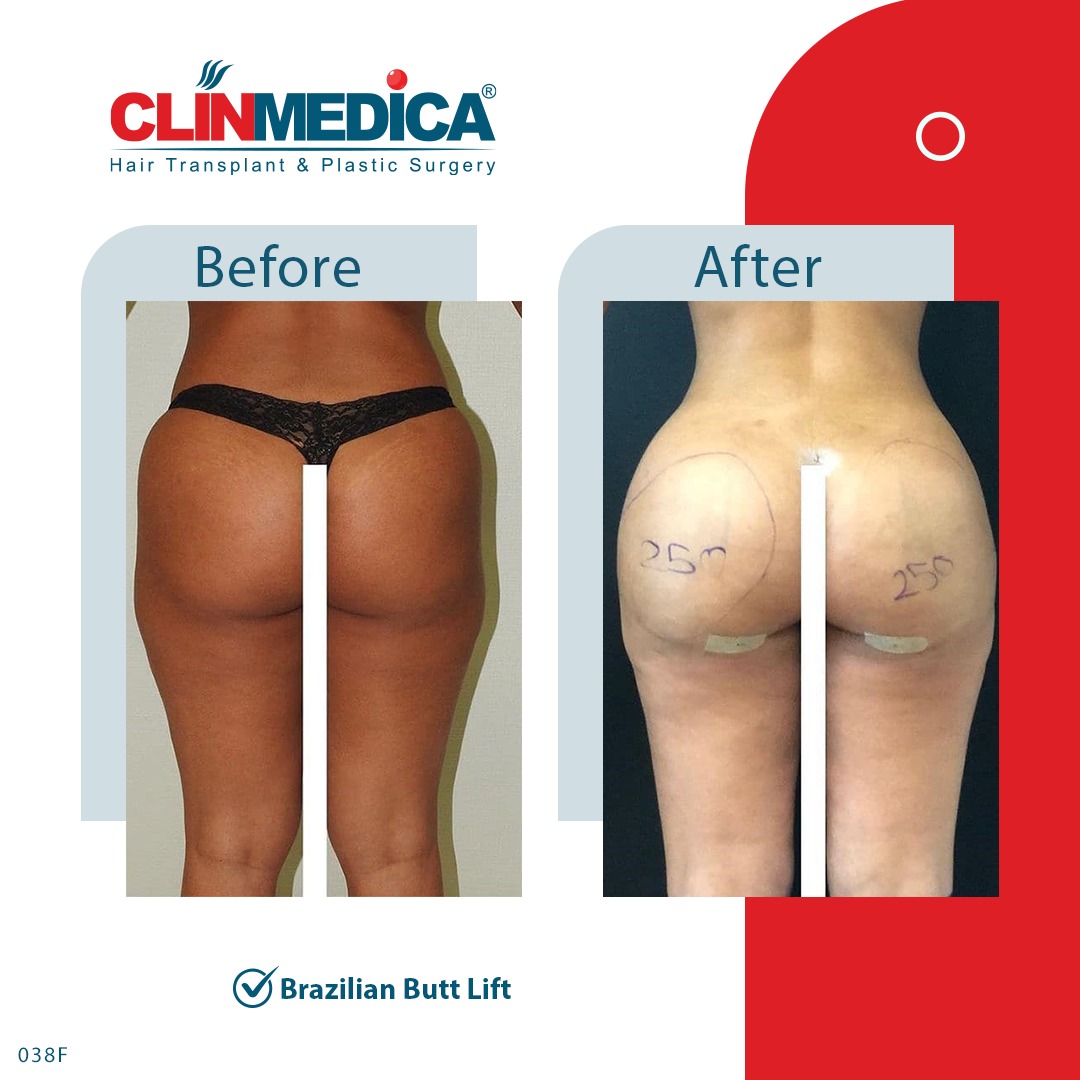 Brazilian Butt BBL - Butt Lifting Before and After Results in Turkey