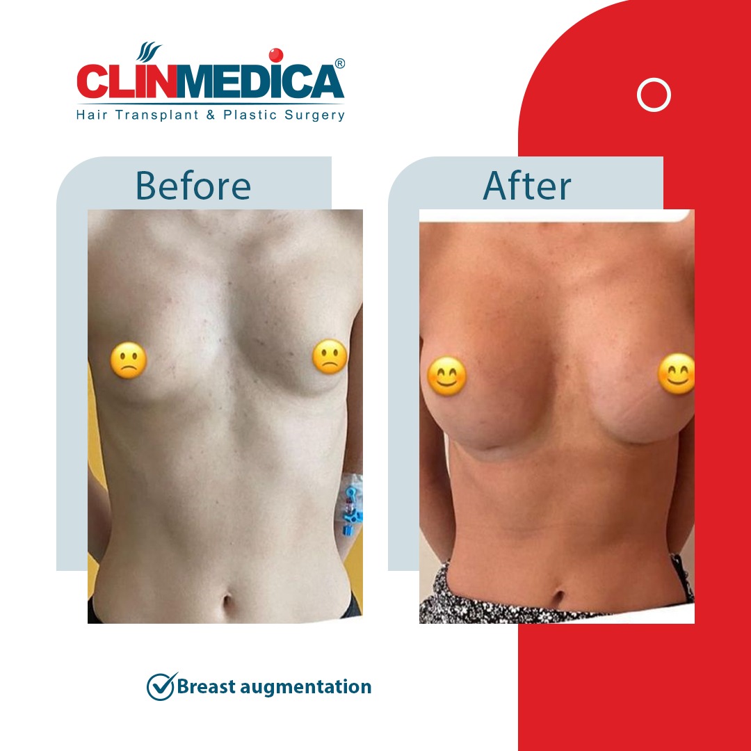 Breast Augmentation Before and After Results in Turkey