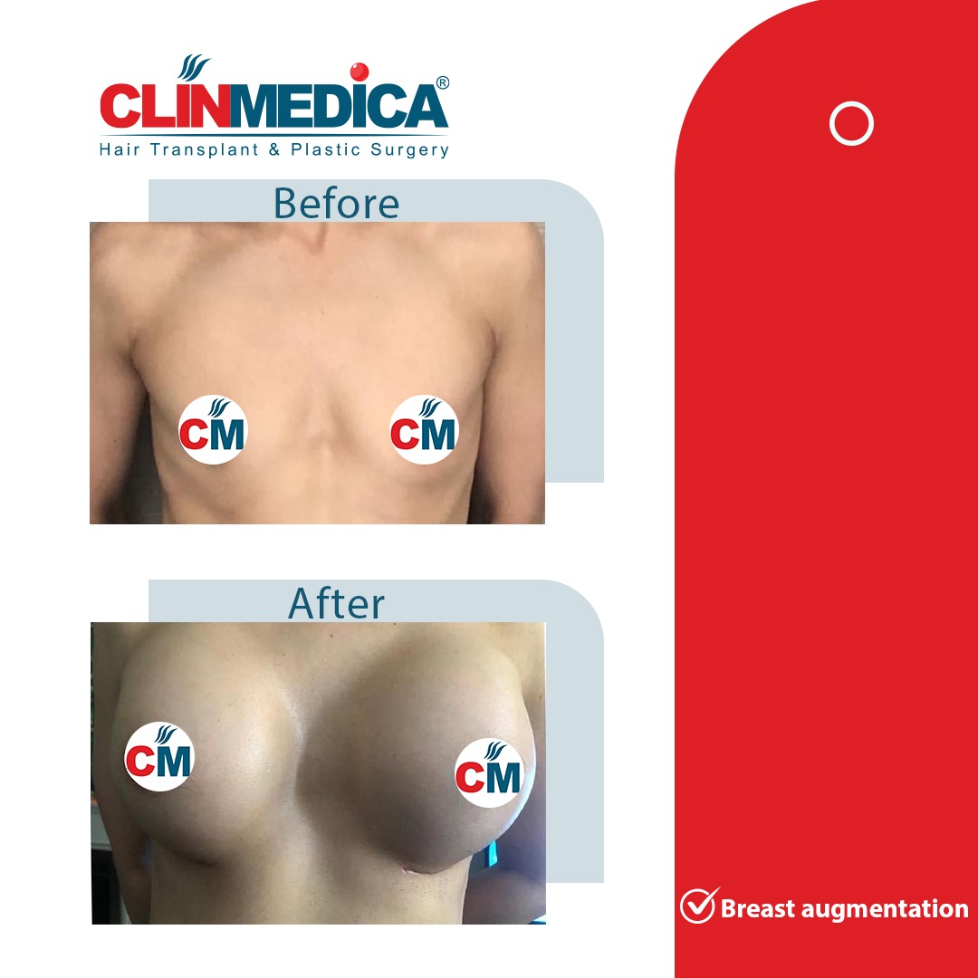 Breast Augmentation Before and After Results in Turkey