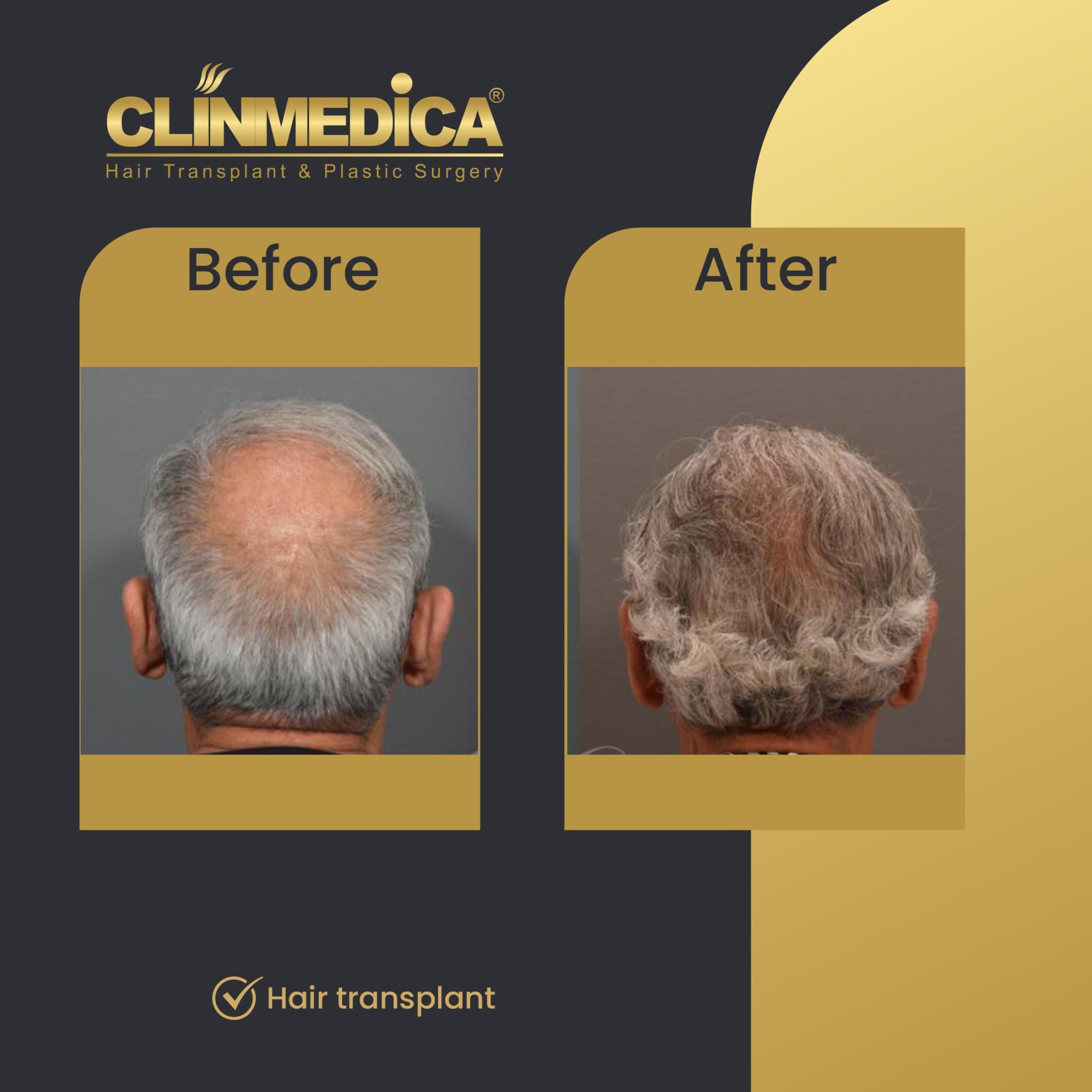 Crown Hair Transplant in Turkey