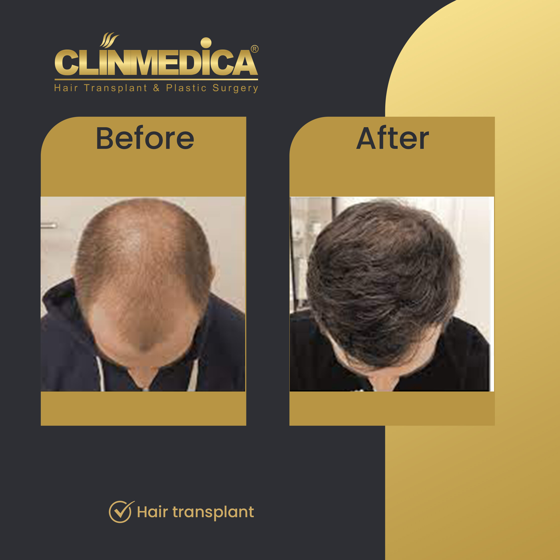Crown Hair Transplant in Turkey