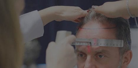 a person measuring a man's forehead to do Hair Transplant Turkey