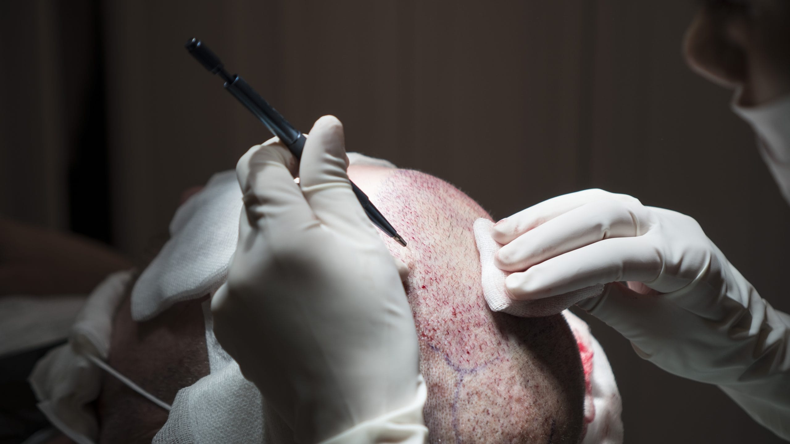 a person with gloves and a scalpel on their Hair Transplant Turkey