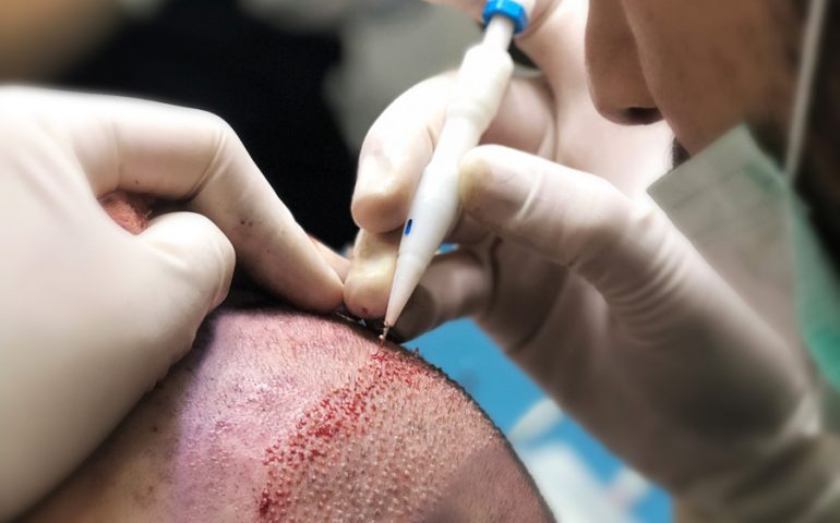 Channel Opening During DHI Hair Transplant Turkey