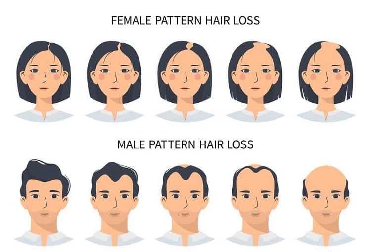 a woman's hair loss to get a Hair Transplant in Turkey